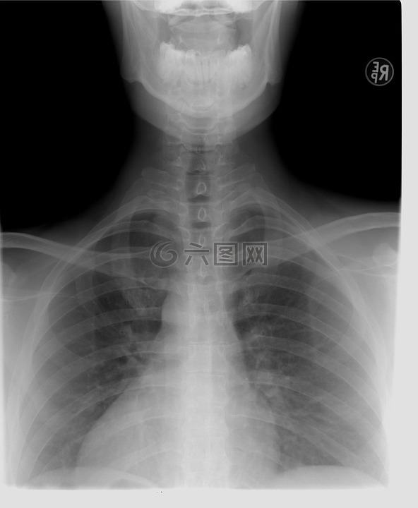 xray,胸椎,診斷