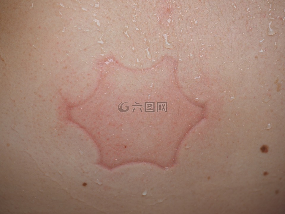 皮膚,再版,壓點(diǎn)