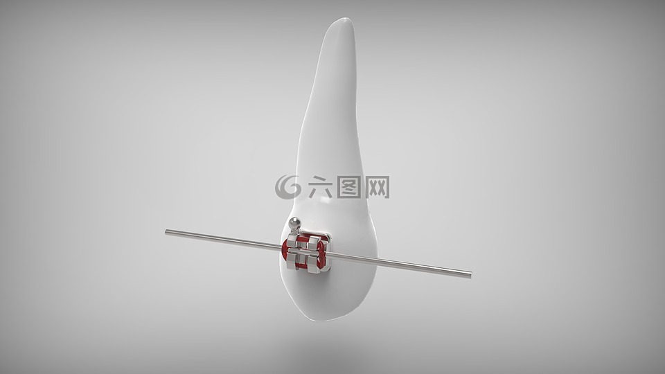 牙套,畸齒矯正術(shù)城堡,線