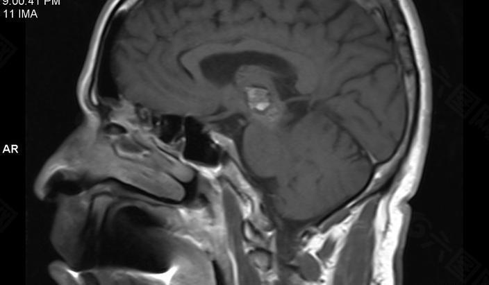 海绵状血管瘤（中大脑的左半部）