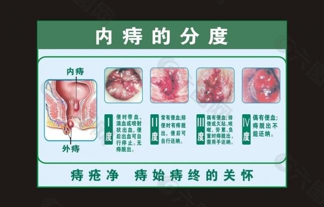 内痔分度图片