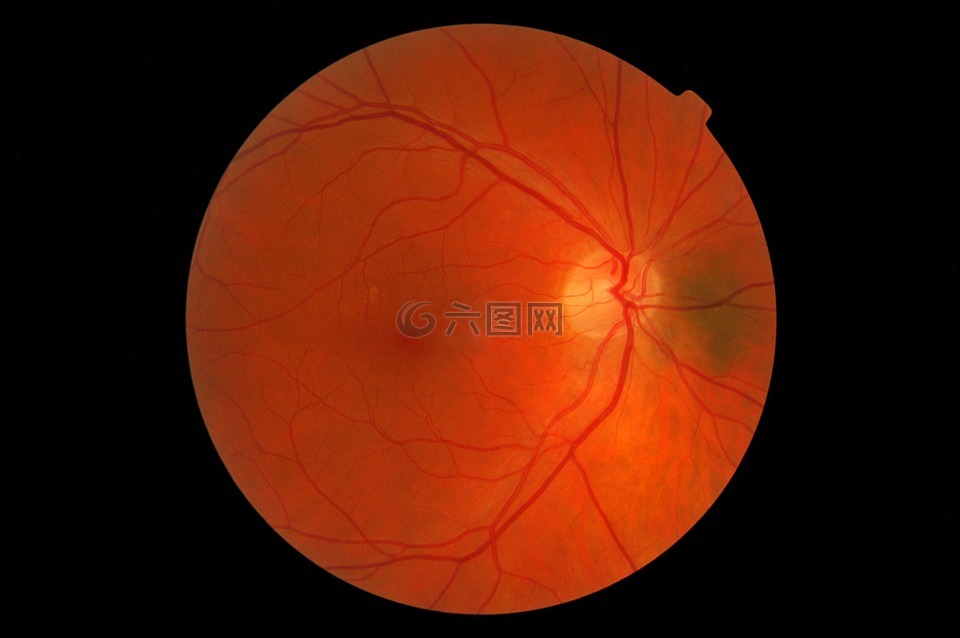 视网膜,痣,眼