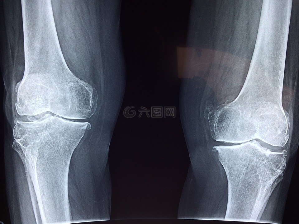 膝关节,x 射线,医疗