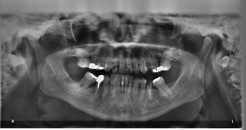 x射线,牙齿,半径