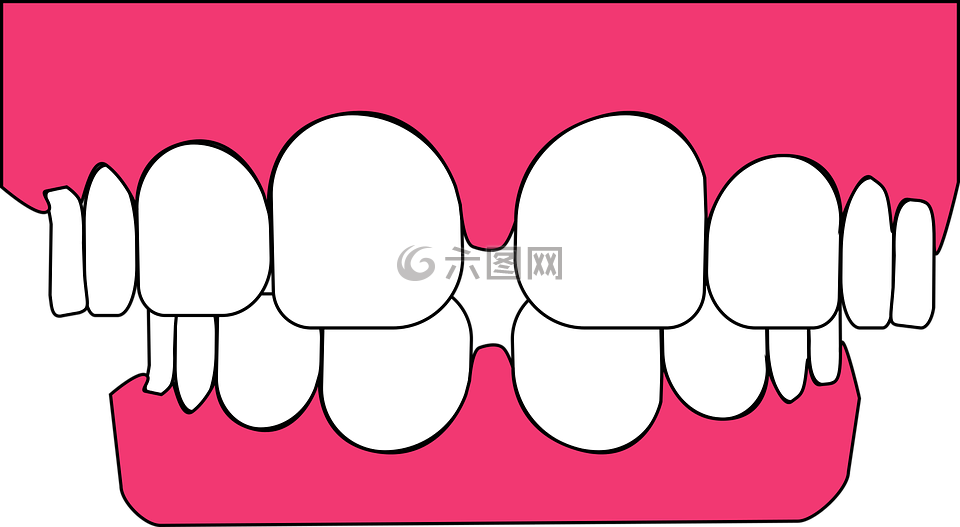 牙齿,牙科,牙龈